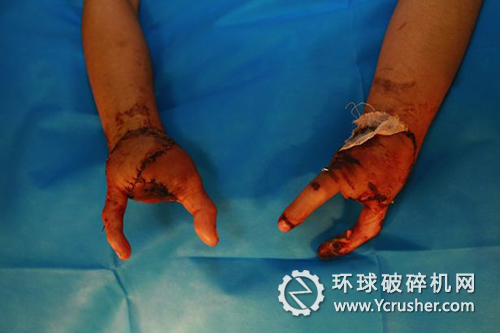 傷者的手接成&ldquo;螯&rdquo;狀。